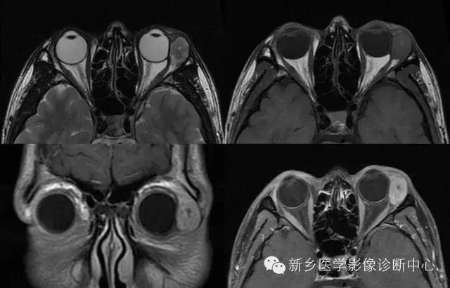 看到泪腺异常,要想到的9种疾病 看到泪腺异常,要想到的9种疾病