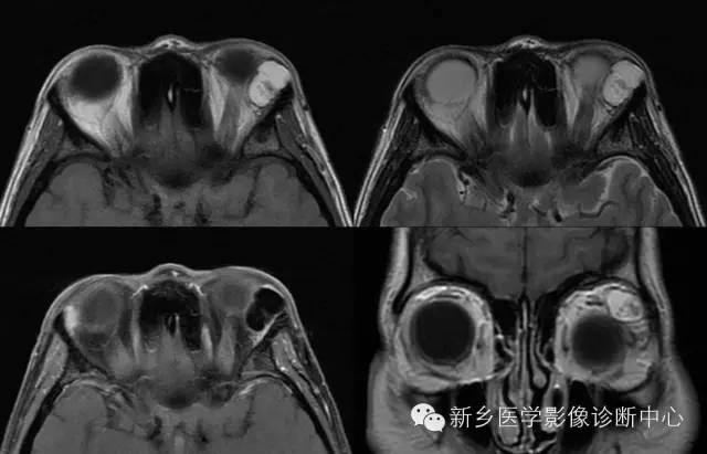 看到泪腺异常,要想到的9种疾病 看到泪腺异常,要想到的9种疾病