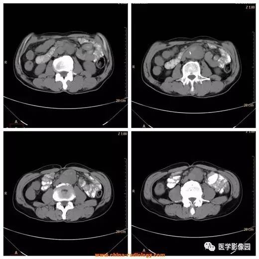 【病例】腹主动脉假性动脉瘤1例CT影像表现 【病例】腹主动脉假性动脉瘤1例CT影像表现