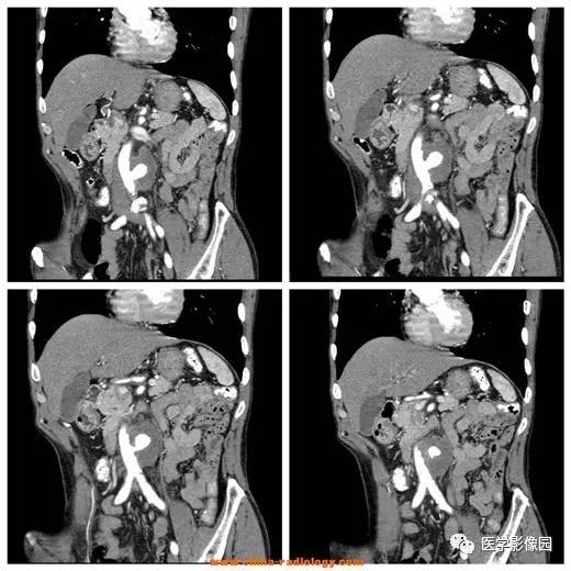 【病例】腹主动脉假性动脉瘤1例CT影像表现 【病例】腹主动脉假性动脉瘤1例CT影像表现