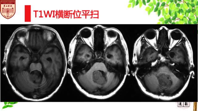 【病例】脉络丛乳头状瘤1例MR影像诊断与鉴别 【病例】脉络丛乳头状瘤1例MR影像诊断与鉴别