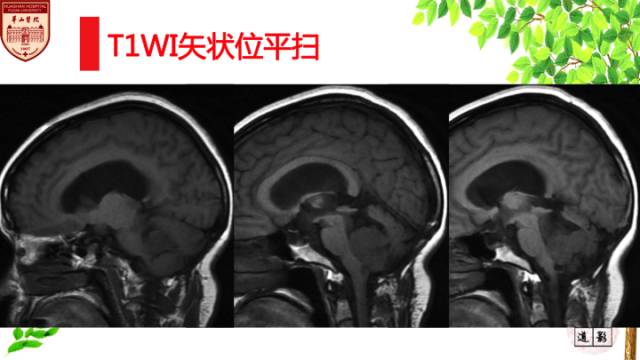 【病例】脉络丛乳头状瘤1例MR影像诊断与鉴别 【病例】脉络丛乳头状瘤1例MR影像诊断与鉴别
