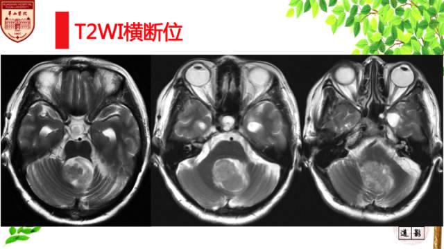 【病例】脉络丛乳头状瘤1例MR影像诊断与鉴别 【病例】脉络丛乳头状瘤1例MR影像诊断与鉴别