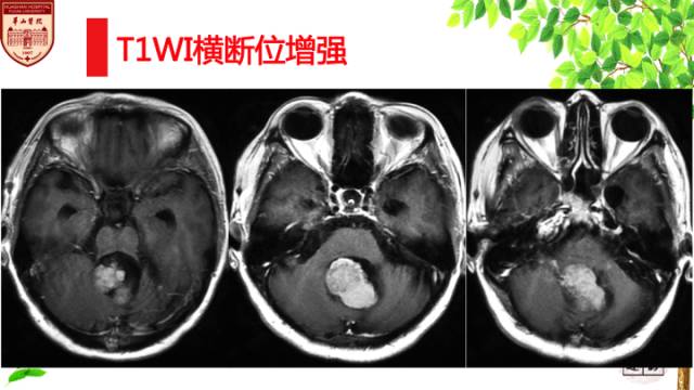 【病例】脉络丛乳头状瘤1例MR影像诊断与鉴别 【病例】脉络丛乳头状瘤1例MR影像诊断与鉴别
