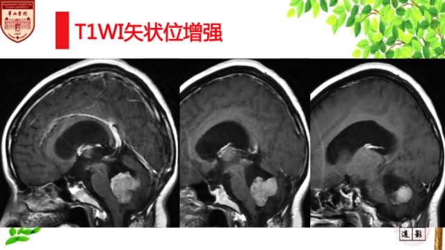 【病例】脉络丛乳头状瘤1例MR影像诊断与鉴别 【病例】脉络丛乳头状瘤1例MR影像诊断与鉴别