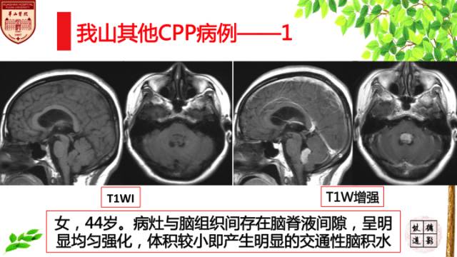 【病例】脉络丛乳头状瘤1例MR影像诊断与鉴别 【病例】脉络丛乳头状瘤1例MR影像诊断与鉴别