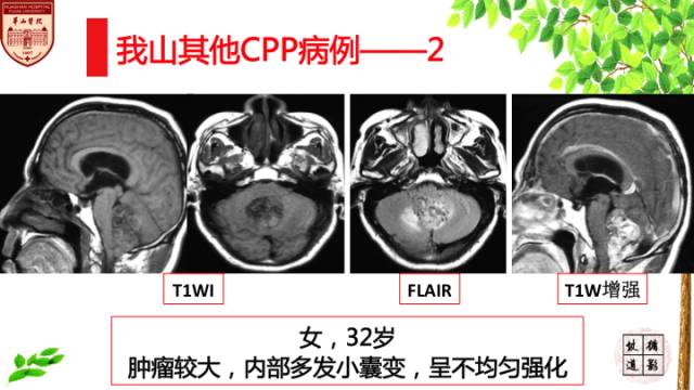 【病例】脉络丛乳头状瘤1例MR影像诊断与鉴别 【病例】脉络丛乳头状瘤1例MR影像诊断与鉴别