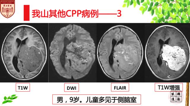 【病例】脉络丛乳头状瘤1例MR影像诊断与鉴别 【病例】脉络丛乳头状瘤1例MR影像诊断与鉴别