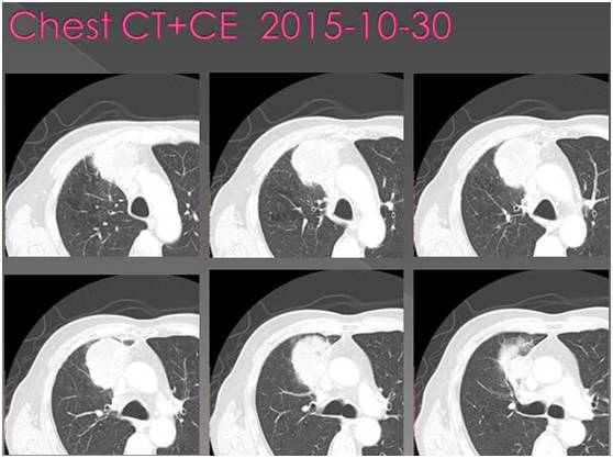 【病例】单发肺转移瘤1例CT影像表现 【病例】单发肺转移瘤1例CT影像表现
