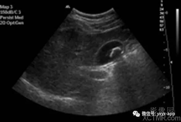 【病例】胆囊结石1例超声影像诊断分析 【病例】胆囊结石1例超声影像诊断分析