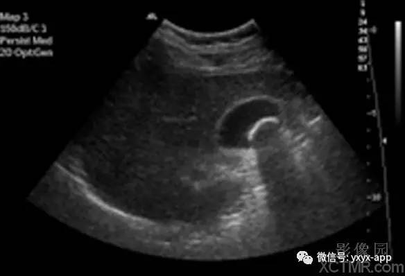 【病例】胆囊结石1例超声影像诊断分析