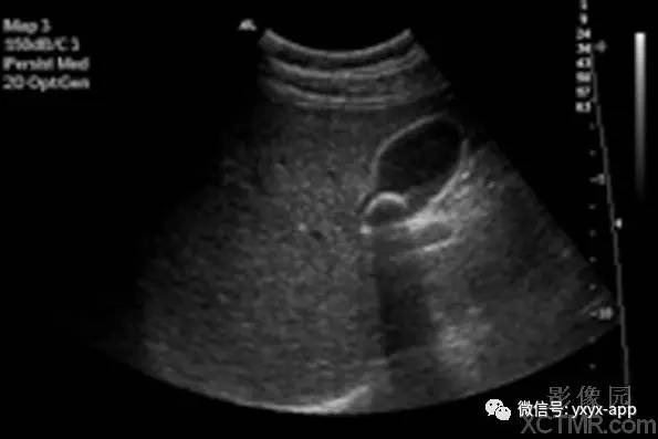 【病例】胆囊结石1例超声影像诊断分析 【病例】胆囊结石1例超声影像诊断分析