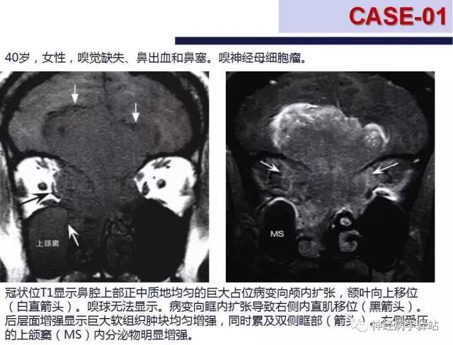 【PPT】嗅神经解剖、临床及影像