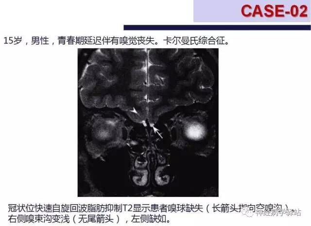 【PPT】嗅神经解剖、临床及影像