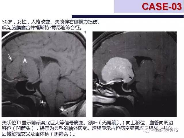 【PPT】嗅神经解剖、临床及影像