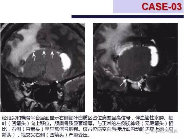 【PPT】嗅神经解剖、临床及影像