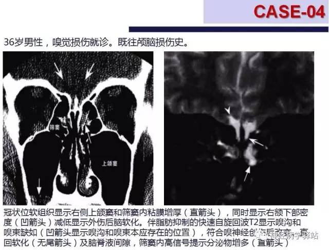 【PPT】嗅神经解剖、临床及影像