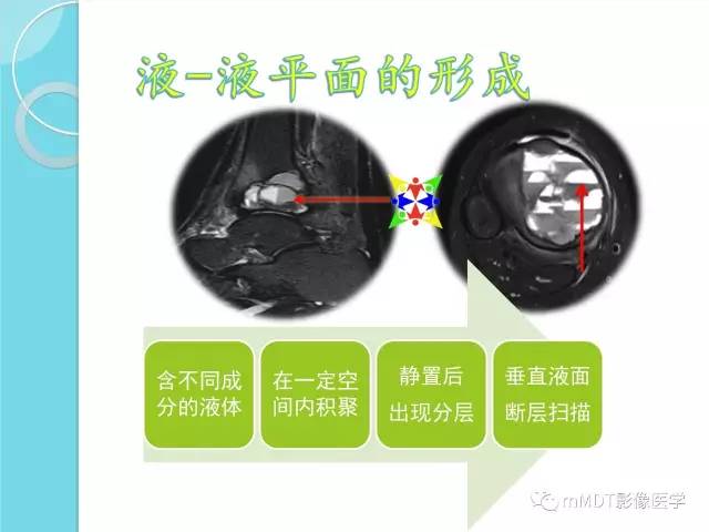 【PPT】液-液平面在骨骼病变影像诊断中的价值