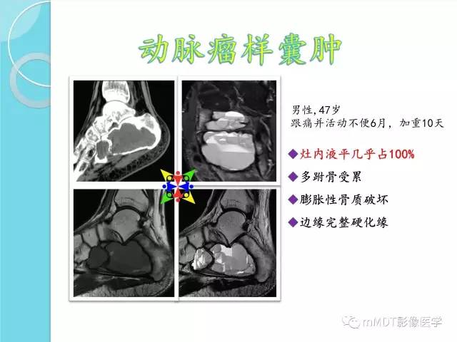 【PPT】液-液平面在骨骼病变影像诊断中的价值