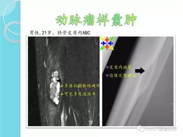 【PPT】液-液平面在骨骼病变影像诊断中的价值