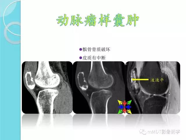 【PPT】液-液平面在骨骼病变影像诊断中的价值