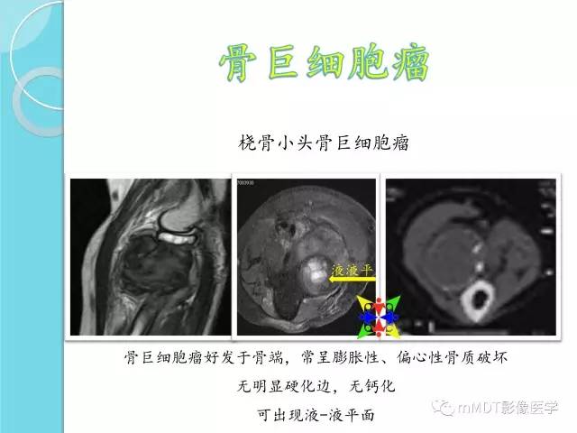 【PPT】液-液平面在骨骼病变影像诊断中的价值