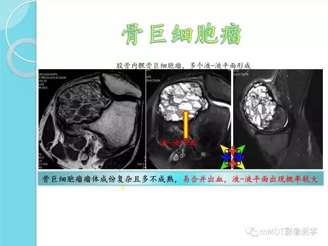 【PPT】液-液平面在骨骼病变影像诊断中的价值