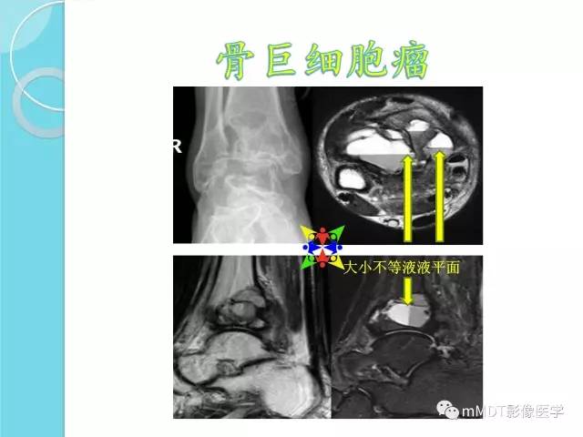 【PPT】液-液平面在骨骼病变影像诊断中的价值
