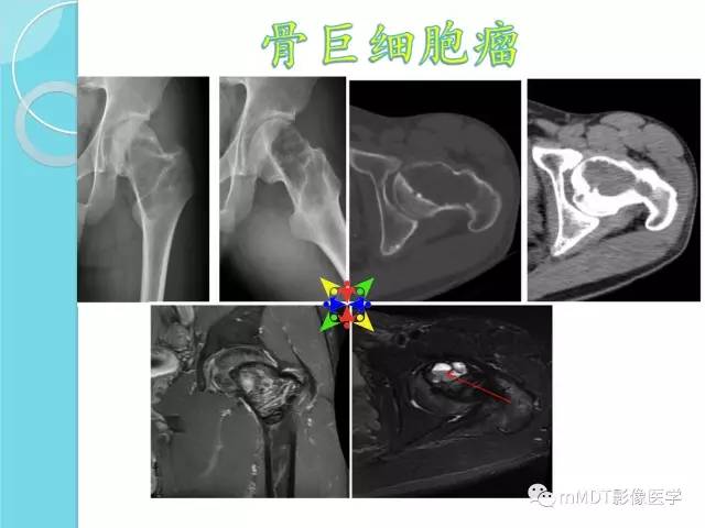 【PPT】液-液平面在骨骼病变影像诊断中的价值