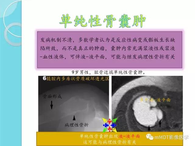 【PPT】液-液平面在骨骼病变影像诊断中的价值