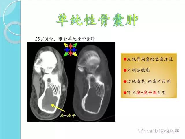 【PPT】液-液平面在骨骼病变影像诊断中的价值