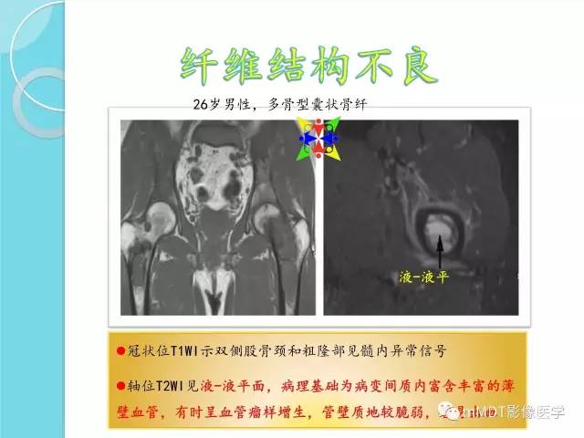 【PPT】液-液平面在骨骼病变影像诊断中的价值