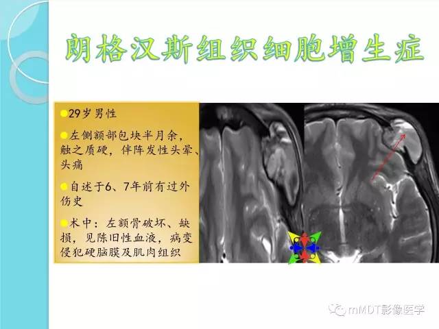 【PPT】液-液平面在骨骼病变影像诊断中的价值