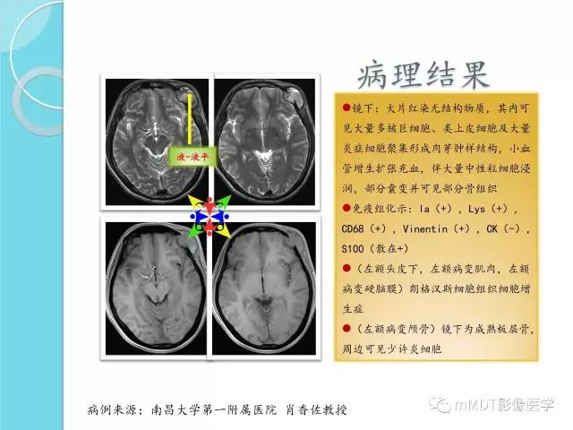 【PPT】液-液平面在骨骼病变影像诊断中的价值
