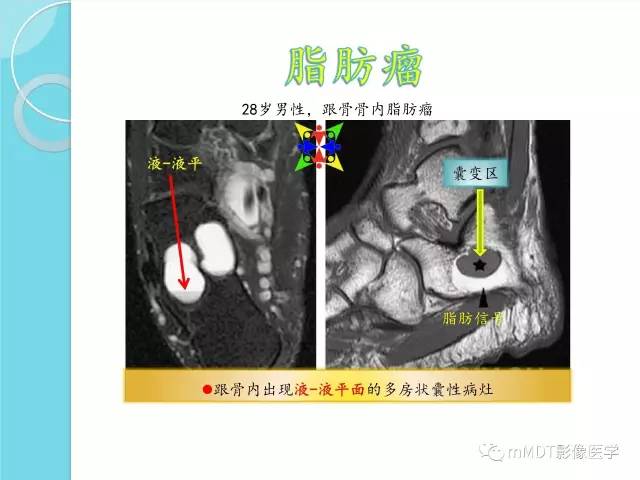 【PPT】液-液平面在骨骼病变影像诊断中的价值