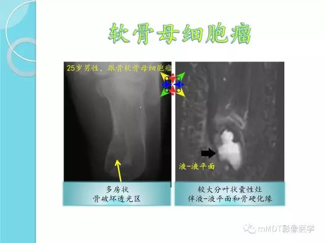 【PPT】液-液平面在骨骼病变影像诊断中的价值