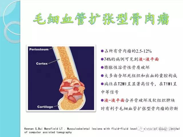 【PPT】液-液平面在骨骼病变影像诊断中的价值