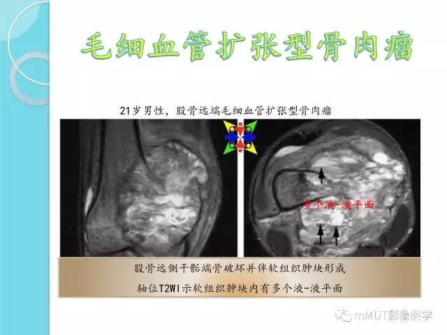 【PPT】液-液平面在骨骼病变影像诊断中的价值