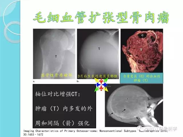 【PPT】液-液平面在骨骼病变影像诊断中的价值