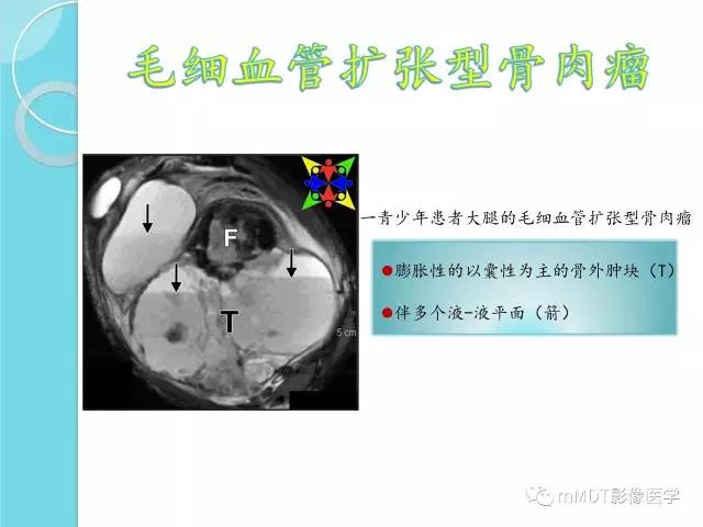 【PPT】液-液平面在骨骼病变影像诊断中的价值