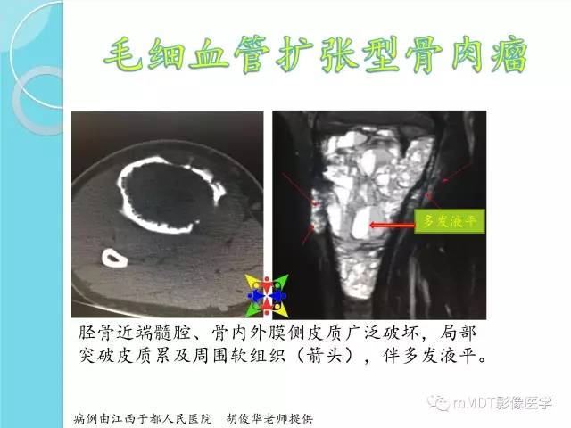 【PPT】液-液平面在骨骼病变影像诊断中的价值