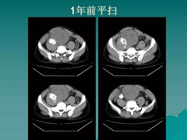 【病例】腹膜后骨外骨肉瘤1例CT影像表现