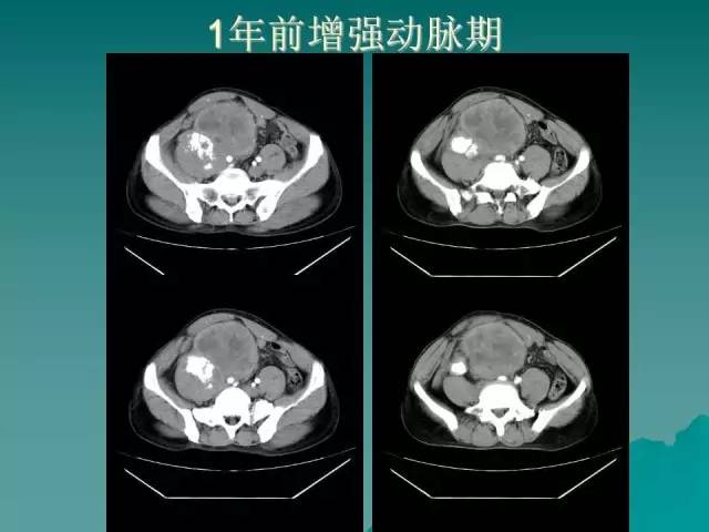 【病例】腹膜后骨外骨肉瘤1例CT影像表现