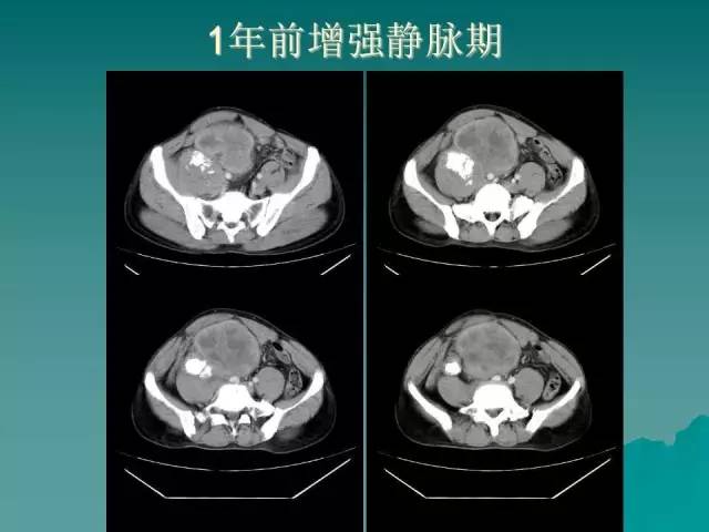 【病例】腹膜后骨外骨肉瘤1例CT影像表现