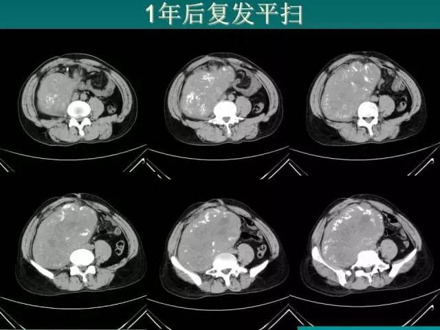 【病例】腹膜后骨外骨肉瘤1例CT影像表现