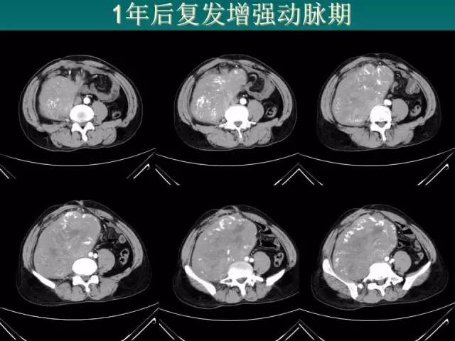 【病例】腹膜后骨外骨肉瘤1例CT影像表现