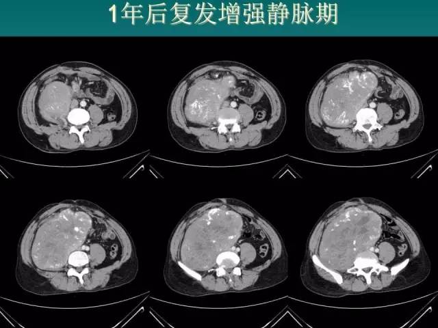 【病例】腹膜后骨外骨肉瘤1例CT影像表现