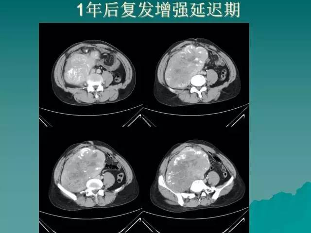 【病例】腹膜后骨外骨肉瘤1例CT影像表现