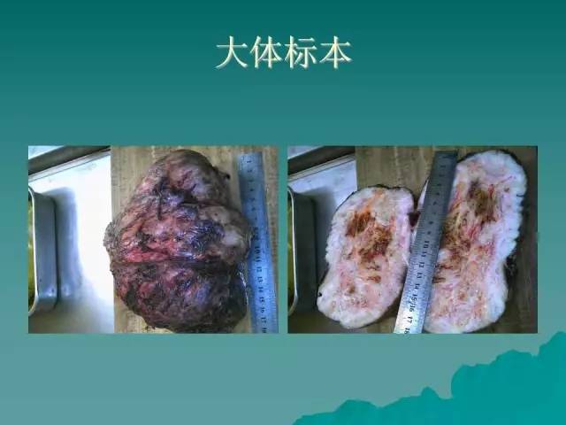 【病例】腹膜后骨外骨肉瘤1例CT影像表现
