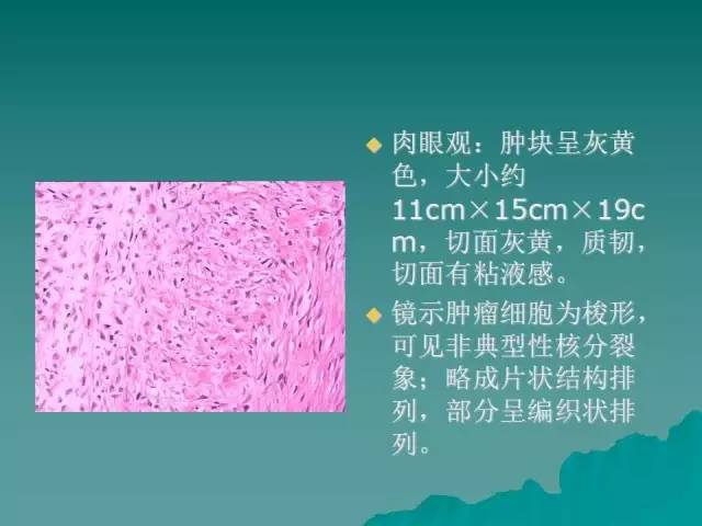 【病例】腹膜后骨外骨肉瘤1例CT影像表现